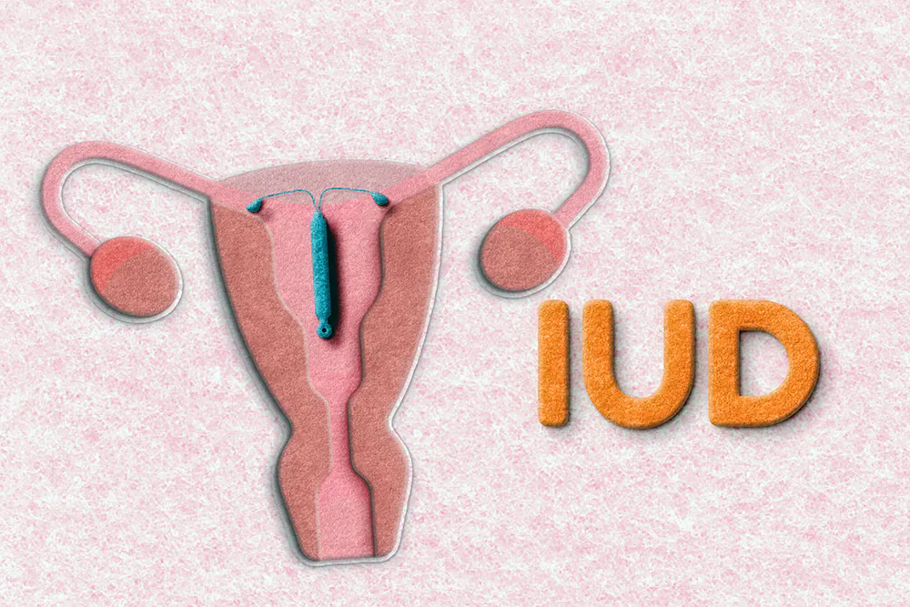 避妊リング（IUD）とは