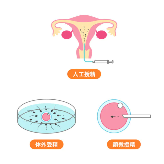 人工授精